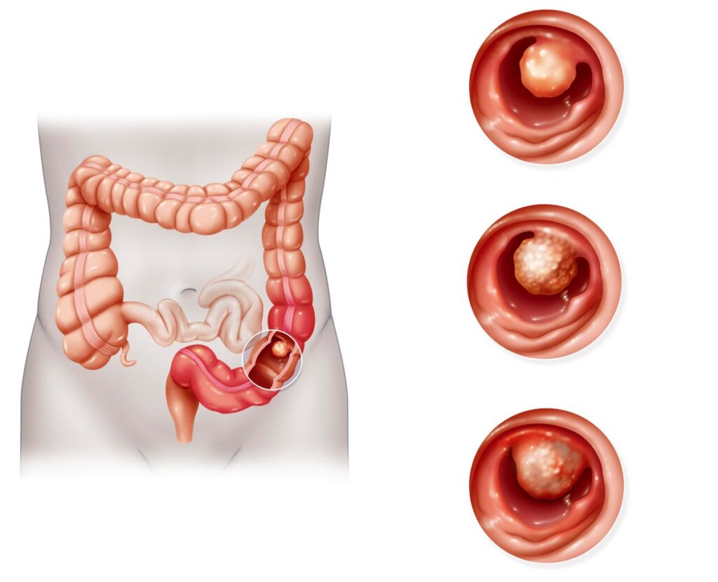 March Is Colorectal Cancer Awareness Month- Here’s What You Should Know