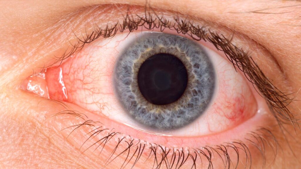 New Covid Variant Causing Pink Eye