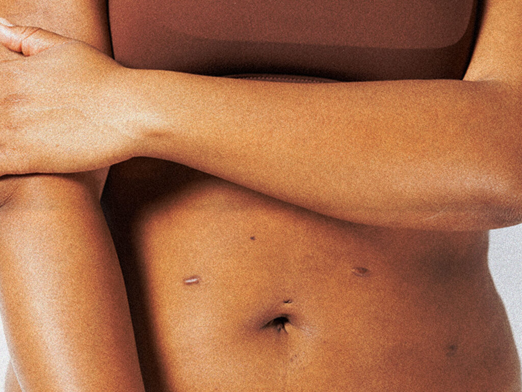 For Me, Scar Removal Is an Act of Self Love