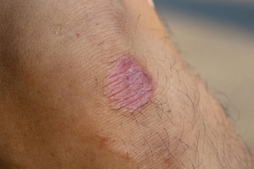 Highly Contagious, Drug-Resistant Ringworm Reported In U.S. For First Time