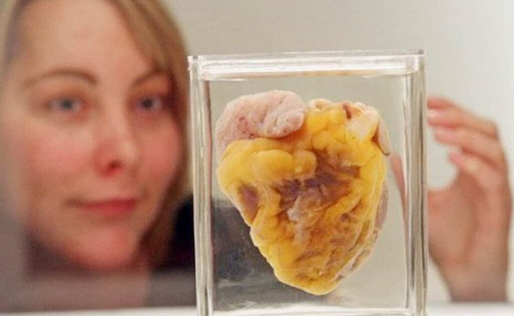 Woman Sees Her Own Heart In Museum, 16 Years After Transplant Surgery