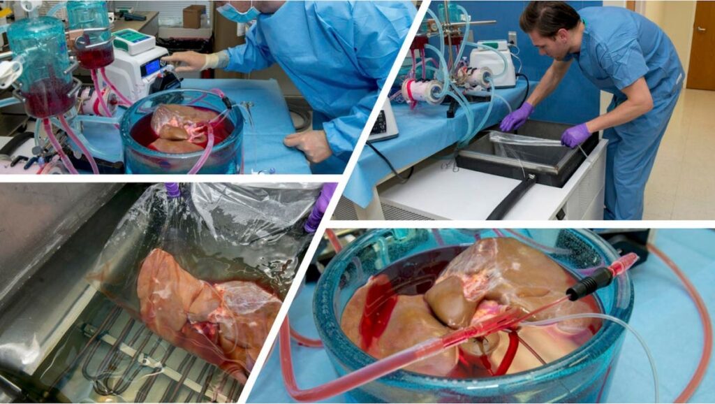 New Breakthroughs In Cryopreservation Poised To Transform Organ Transplantation