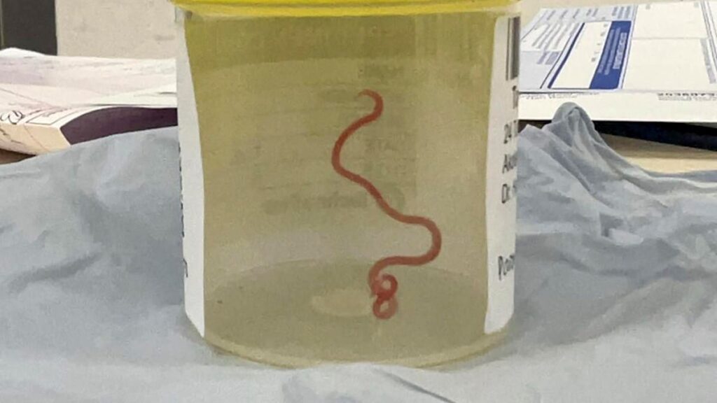 Live Worm Found In Woman’s Brain Is Rare—But Common Deadly Parasites Already Plague Billions Of People