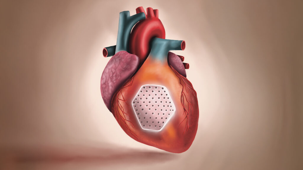BioVAT stem cell heart patch offers hope for heart failure patients BioVAT stem cell heart patch offers hope for heart failure patients