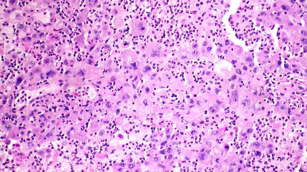 Merck-Kelun lung cancer drug cut tumor progression risk by 65% Merck-Kelun lung cancer drug cut tumor progression risk by 65%