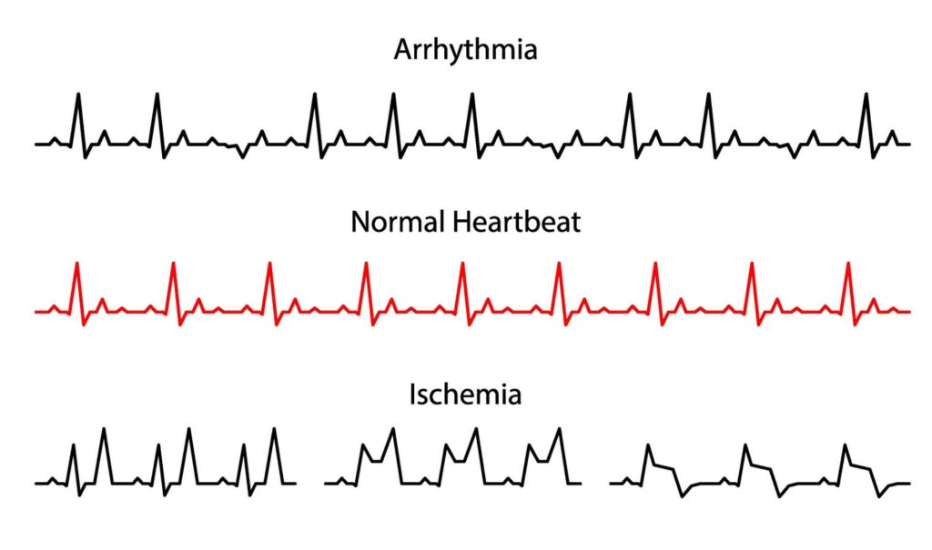 How Artificial Intelligence Discovered A New Way To Detect Patients At Risk Of Cardiac Death How Artificial Intelligence Discovered A New Way To Detect Patients At Risk Of Cardiac Death