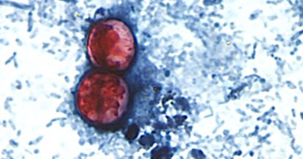 Outbreak Of Parasite That Causes Explosive Diarrhea Grows To More Than 1,000 Cases Outbreak Of Parasite That Causes Explosive Diarrhea Grows To More Than 1,000 Cases