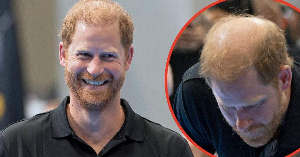 Prince Harry Faces Fresh Bald Mockery After Hair Comments Prince Harry Faces Fresh Bald Mockery After Hair Comments