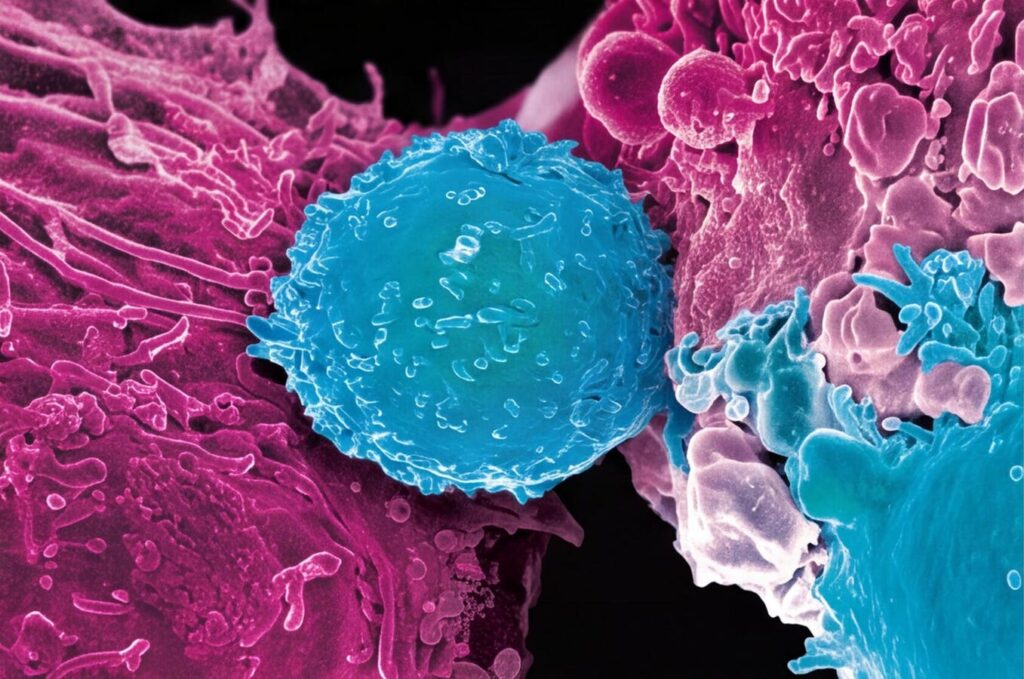 The Remarkable Success Of CAR T For Lymphoma 10 Years Later The Remarkable Success Of CAR T For Lymphoma 10 Years Later