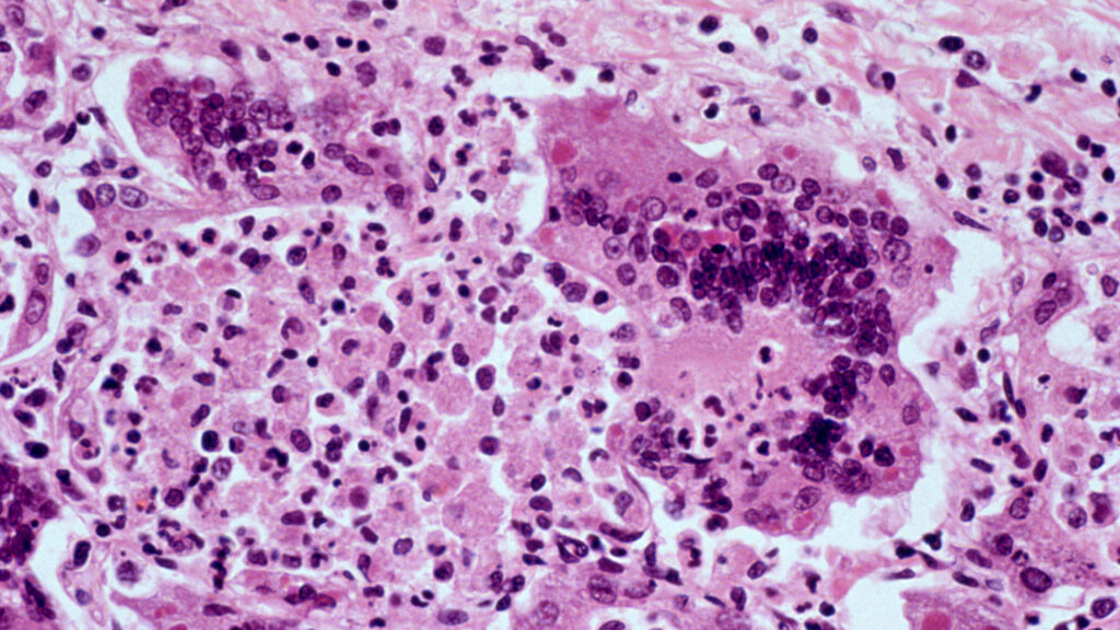 Measles deaths, Heidi Overton, radiology AI: Morning Rounds Measles deaths, Heidi Overton, radiology AI: Morning Rounds