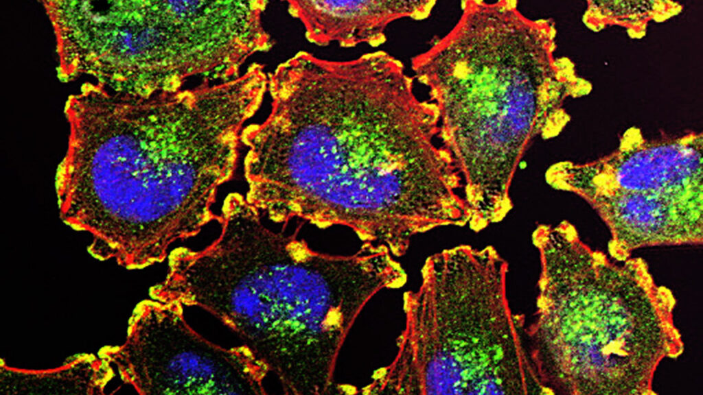 After melanoma diagnosis, a cancer vaccine gave a patient hope After melanoma diagnosis, a cancer vaccine gave a patient hope